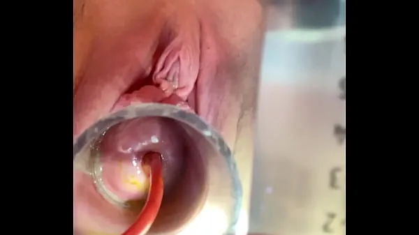 I migliori video Cries from as catheter balloon expands cool